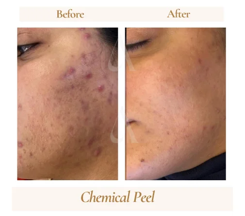 Chemical peel before and after at House of Aetheria, Gurugram