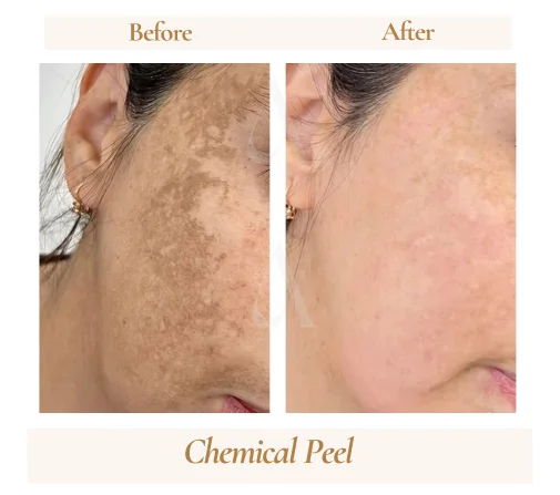 Chemical peel before and after result, House of Aetheria