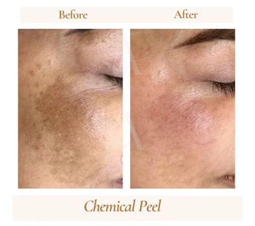 Chemical peel skin improvement before and after, House of Aetheria