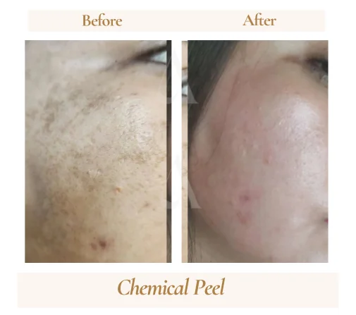 Chemical peel pigmentation before and after, House of Aetheria