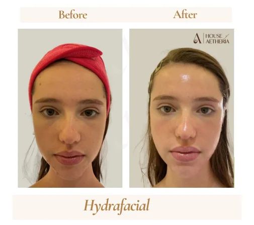 HydraFacial before and after at House of Aetheria, Gurugram