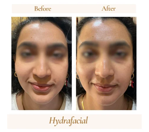 HydraFacial skin glow before and after, House of Aetheria Gurugram