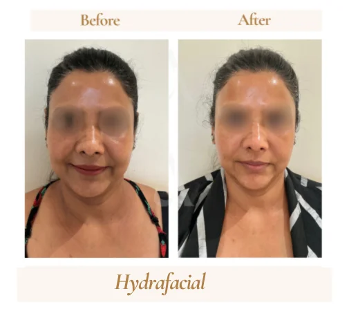 HydraFacial hydration before and after, House of Aetheria Gurugram