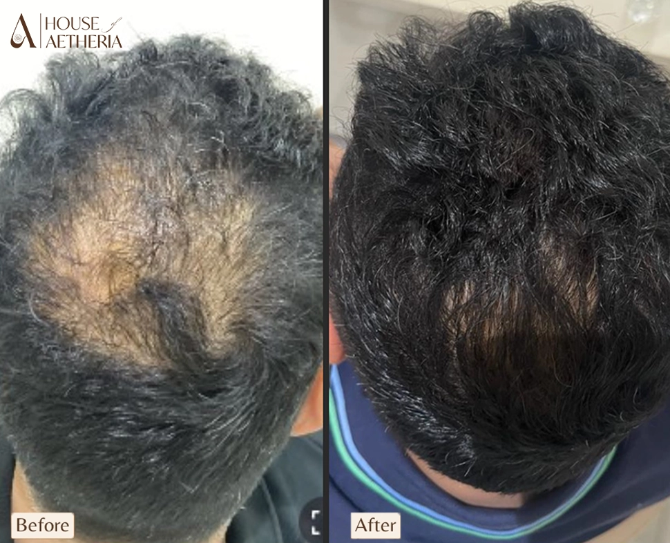 PRP hair treatment before and after at House of Aetheria, Gurugram