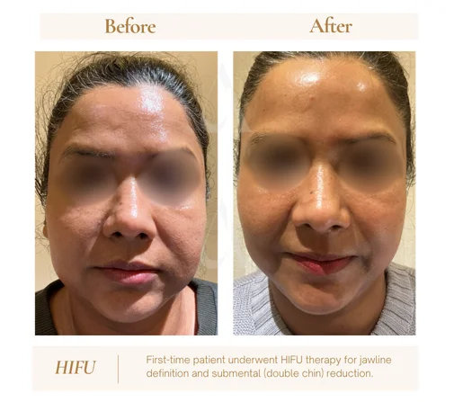 HIFU face lifting before and after, first-time patient, House of Aetheria Gurugram